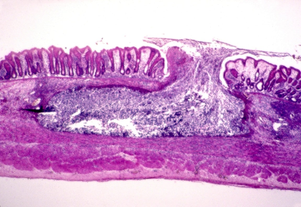 Am Biasis Entamoeba Histolytica Freie Bilder