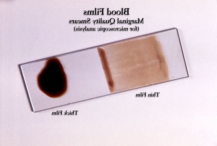 prepared, slide, offers, example, appearance, marginal, quality, thick, thin, film, blood smears