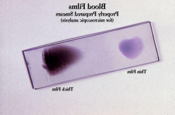 slide, example, prepared, thick, thin, film, blood smears, examined