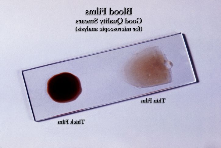 prepared, slide, offers, good, example, thick, thin, blood smear, examined, microscope