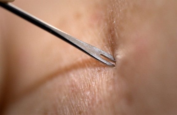 clinician, demonstrates, bifurcated, needle