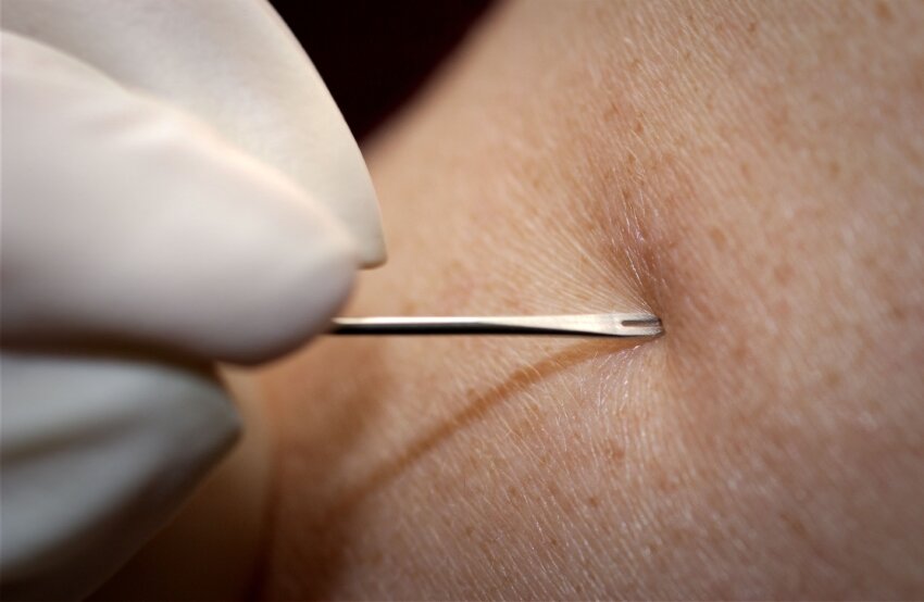 free-picture-up-close-details-image-bifurcated-needle