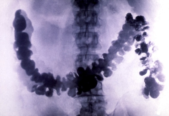 amebiasis, radiograph, barium, filled, colon