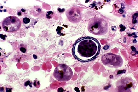 brain, tissue, centrally, acanthamoeba cyst acanthamoeba
