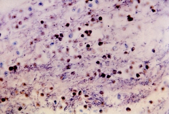 micrograph, meningeal, infection, bacillus anthracis, bacteria, stain