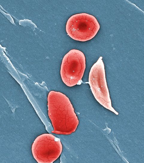 comparative, ultrastructural, morphologie, entre, normal, rouge, le sang, les cellules, les globules rouges, la faucille, cellule