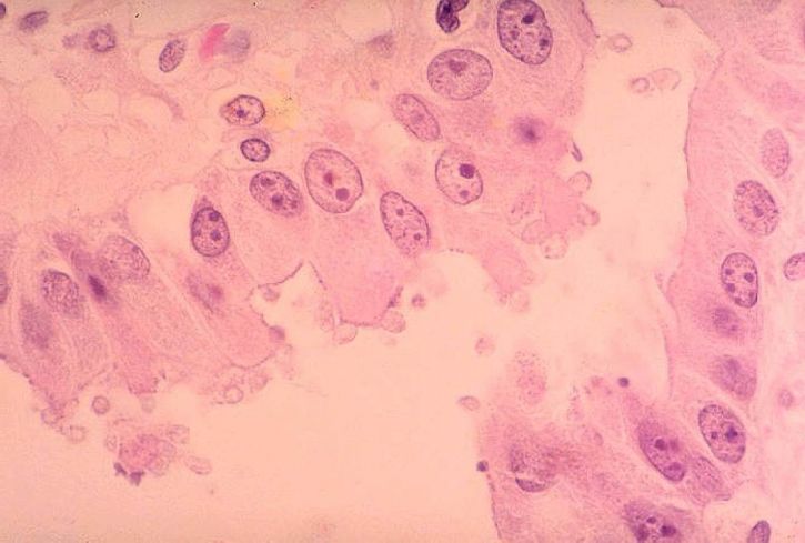 Histopatologi, cryptosporidiosis, kandung empedu