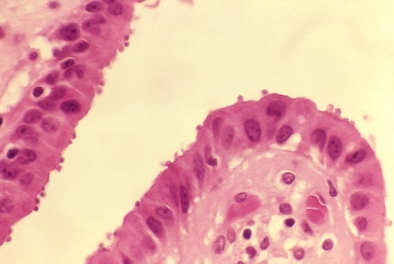 Histopatologia, vesícula biliar, epitélio, mostra, numerosos, cryptosporidium, superfícies luminal, organismos,