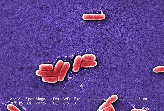 coli O157, fertőzés, súlyos, véres, hasmenés, hasi, görcsök