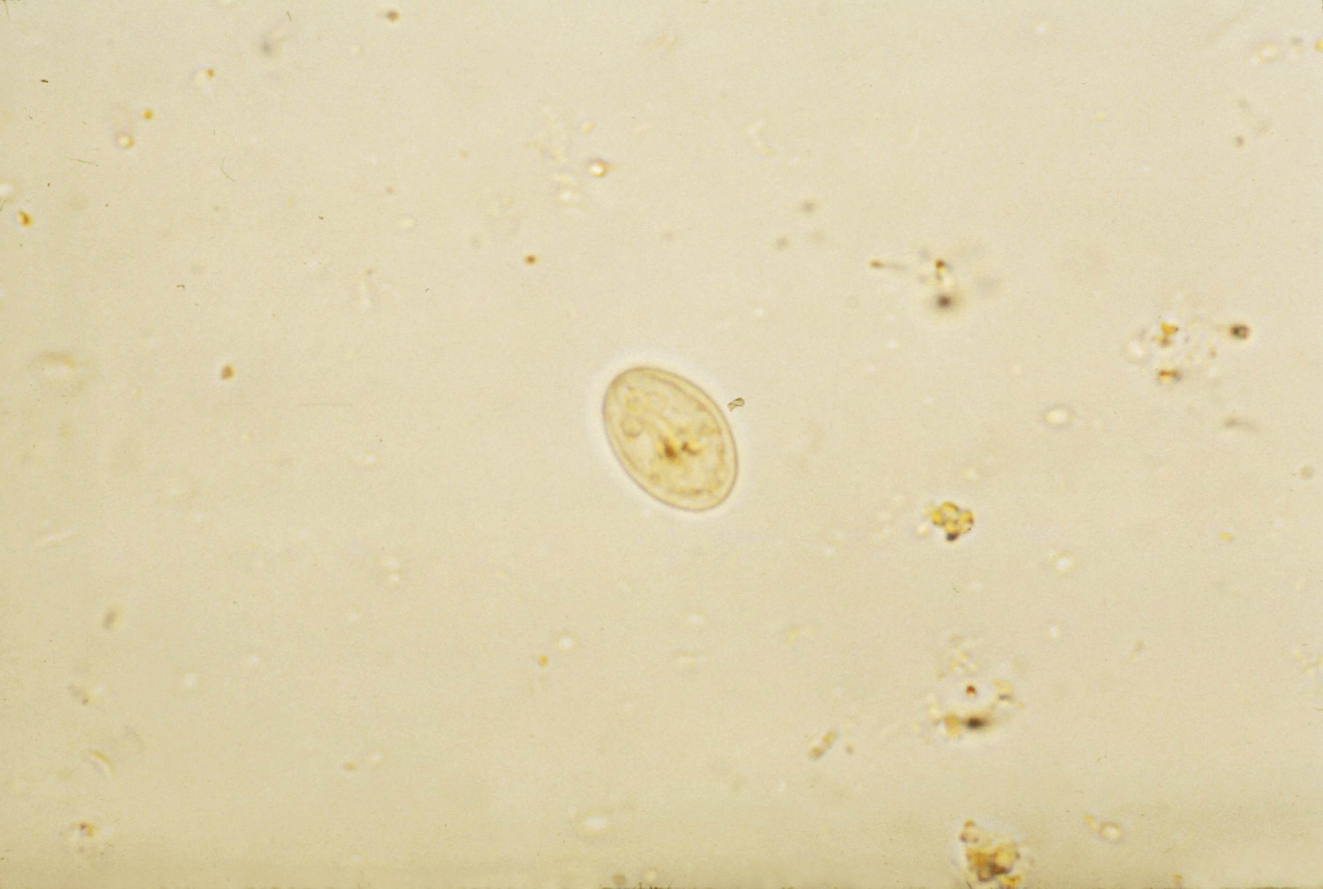 Parazit lamblia - Giardia diarrhea vomiting. Gyomor-bélhurut