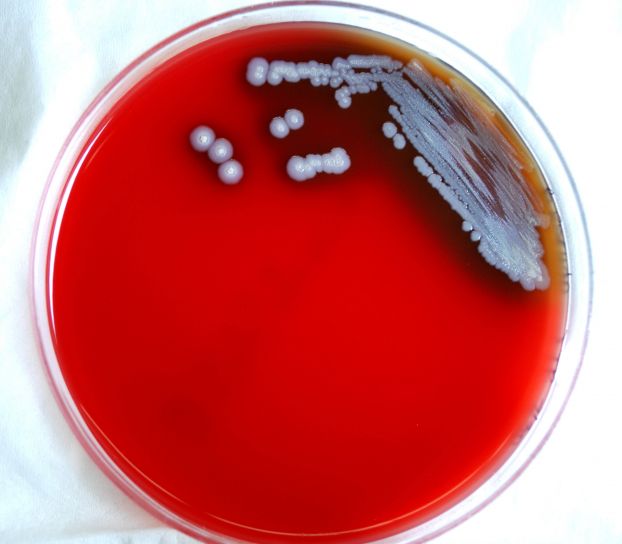 melioidosis, whitmores, betegség, fertőző betegségek, baktériumok, burkholderia pseudomallei