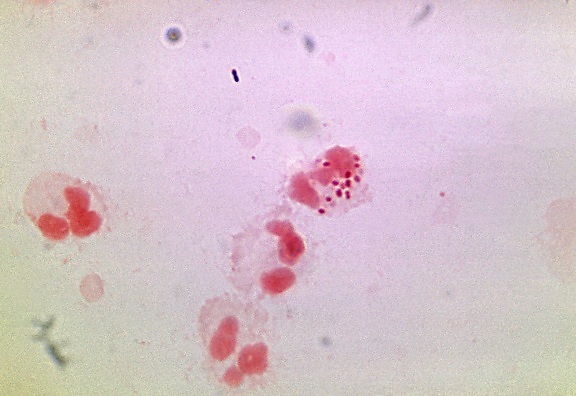Neisseria gonorrhoeae, присутствие, смешанная, бактерии, флора, обратите внимание, некротические, нейтрофильные