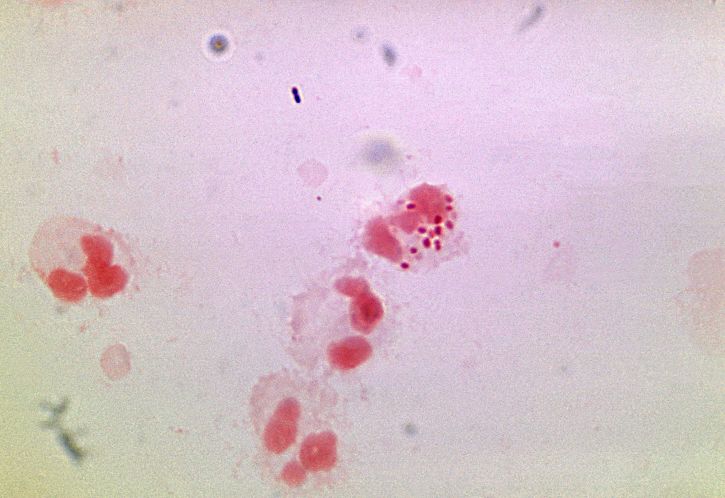 Neisseria gonorrhoeae, přítomnost, smíšené, bakterie, flora, poznámky, nekrotické, neutrofilů