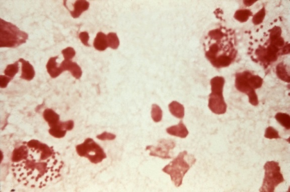 gonorrhoeae, diplococci intracellular ชั้นนำ เป็นบวก วินิจฉัย หนองในแท้