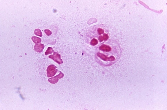 neisseria gonorrhoeae, differential, diagnosis