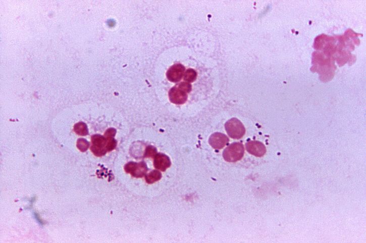 nespecifični uretritis, prisutnost, miješana flora, nekoliko, bakterije, povezane, neutrofili
