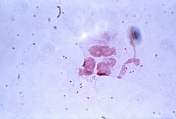 extracellulare, gonorrhoeae, diplococchi, bianco, sangue, cellule