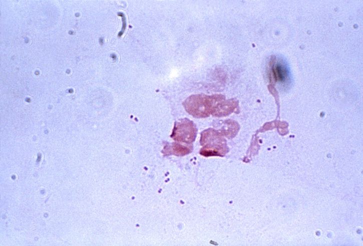 ngoại bào, gonorrhoeae, diplococci, da trắng, máu, tế bào