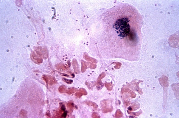 polymorphonuclear leukocytes, accompanying, extracellular, diplococci