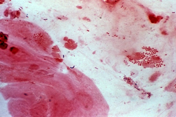 photomicrograph, neisseria gonorrhoeae, cervical, smear, gram, stain, technique