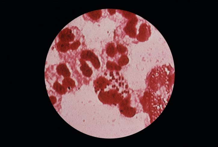 húgycső, lezárása, minta, gramm, negatív, diplococcus neisseria gonorrhoeae