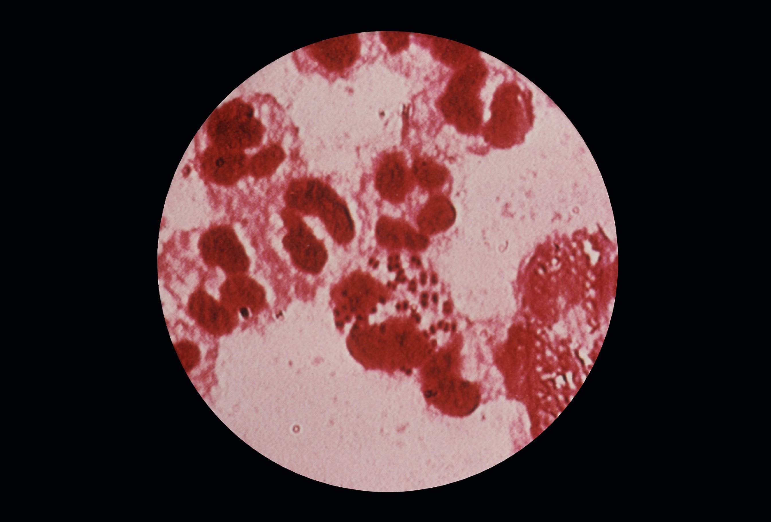 Imagen Gratis Uretral Descarga Muestra Gramo Negativo Diplococcus Neisseria Gonorrhoeae