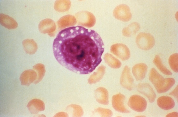 micrograph, atypical, enlarged, lymphocyte, blood smear, patient