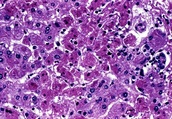 cytoarchitectural, histopathologic, detected, liver