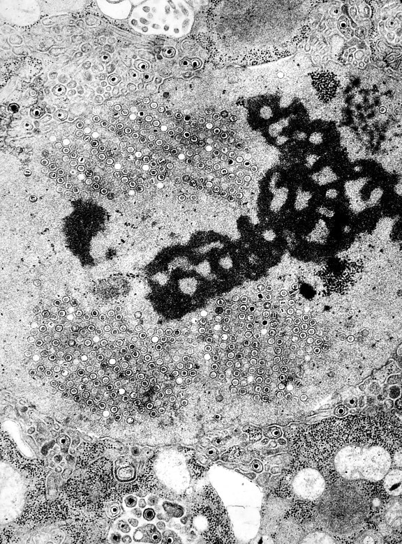 simplex ไวรัส เย็น แผล อวัยวะเพศ โรคเริม