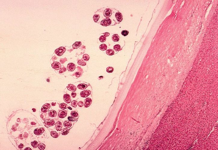 histopatologisk echinococcus granulosus, hydatid, cyste, og får