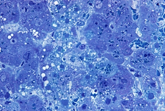 photomicrograph, hepatitis, lassa, virus, toluidine, blue, azure, stain, magnified, 500x