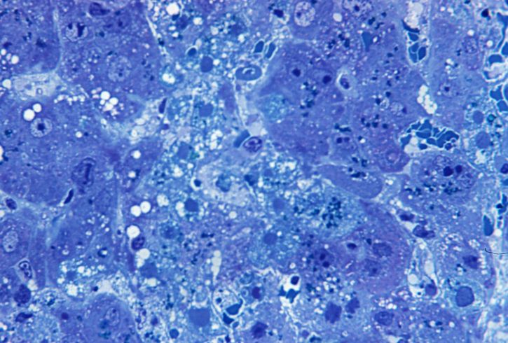 photomicrograph, hepatitis, lassa, virus, toluidin, blå, azure, bejdse, forstørret, 500 x