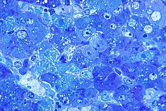Fotomicrografia, shows, hepatite, lassa, vírus, toluidina, azul, azure, mancha