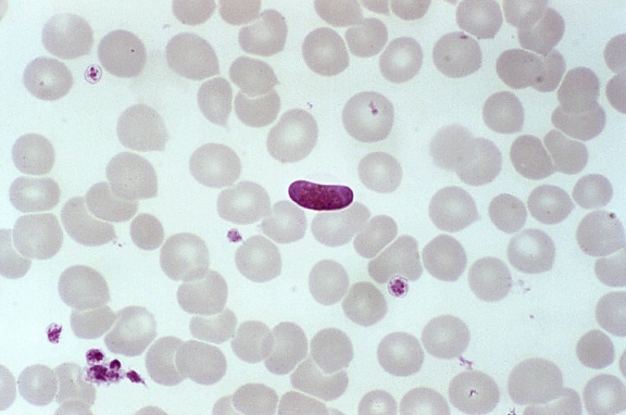 Blood uitstrijkje, bevat, microgametocyte, parasiet, plasmodium falciparum