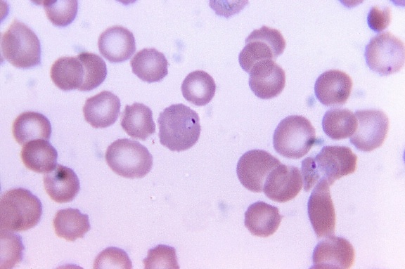 striscio di sangue, al microscopio, vivax, male, rivelare, schuffners, puntini