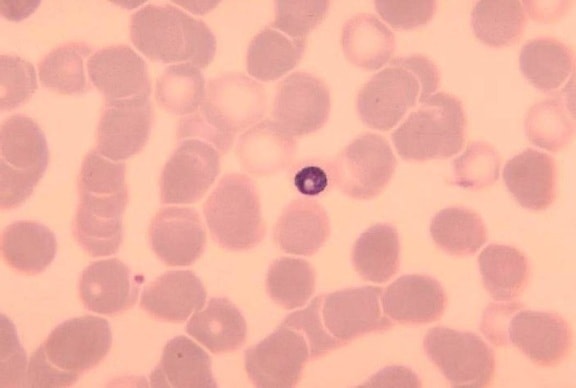 krevní roztěr, kompaktní, staré, trophozoite, plasmodium malariae