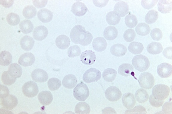 crepacci, rosso, sangue, cellule, l'infezione, falciparum, parassita, alcune tecniche,