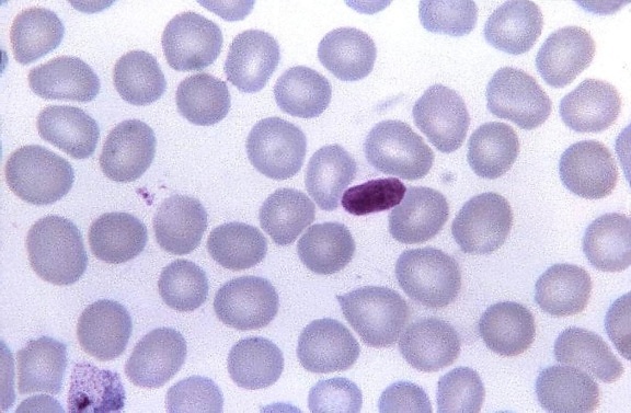 micrographie, cellules, sang, artefact, confondu, le paludisme, un parasite, une infection
