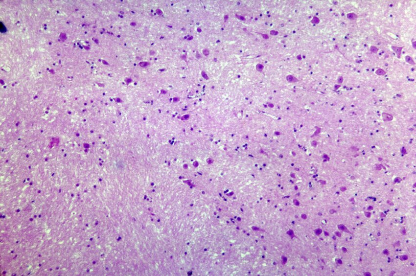Free Picture Histopathology Malaria Brain Plasmodium Falciparum