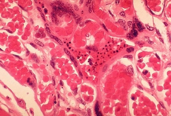 histopatología, Plasmodium falciparum, la malaria, la placenta
