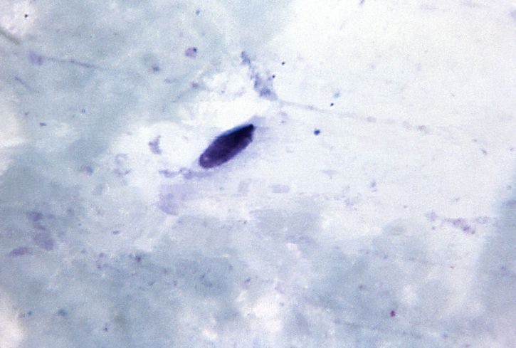 厚さ、フィルム、顕微鏡写真、細長い、アーティファクト、胞子、密接に似ている、熱帯熱マラリア原虫、生殖母体、マグ、1125 x