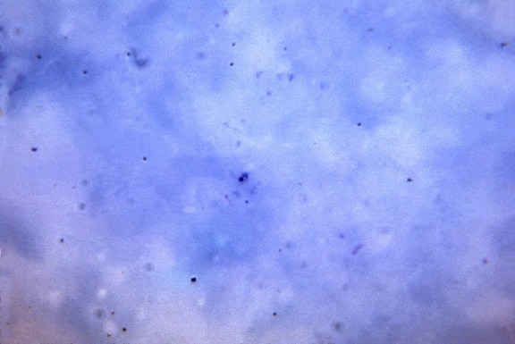 μικρογραφία, συμπαγής, δαχτυλίδι, μορφή, plasmodium vivax, trophozoite, schuffners, τελείες, mag, 1125 x