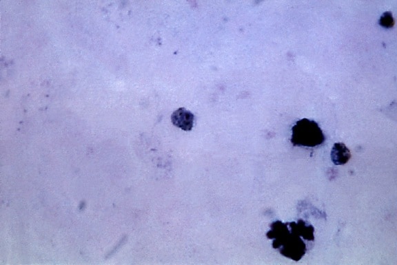 micrograph, mature, plasmodium malariae, trophozoite, prominent, pigmentation