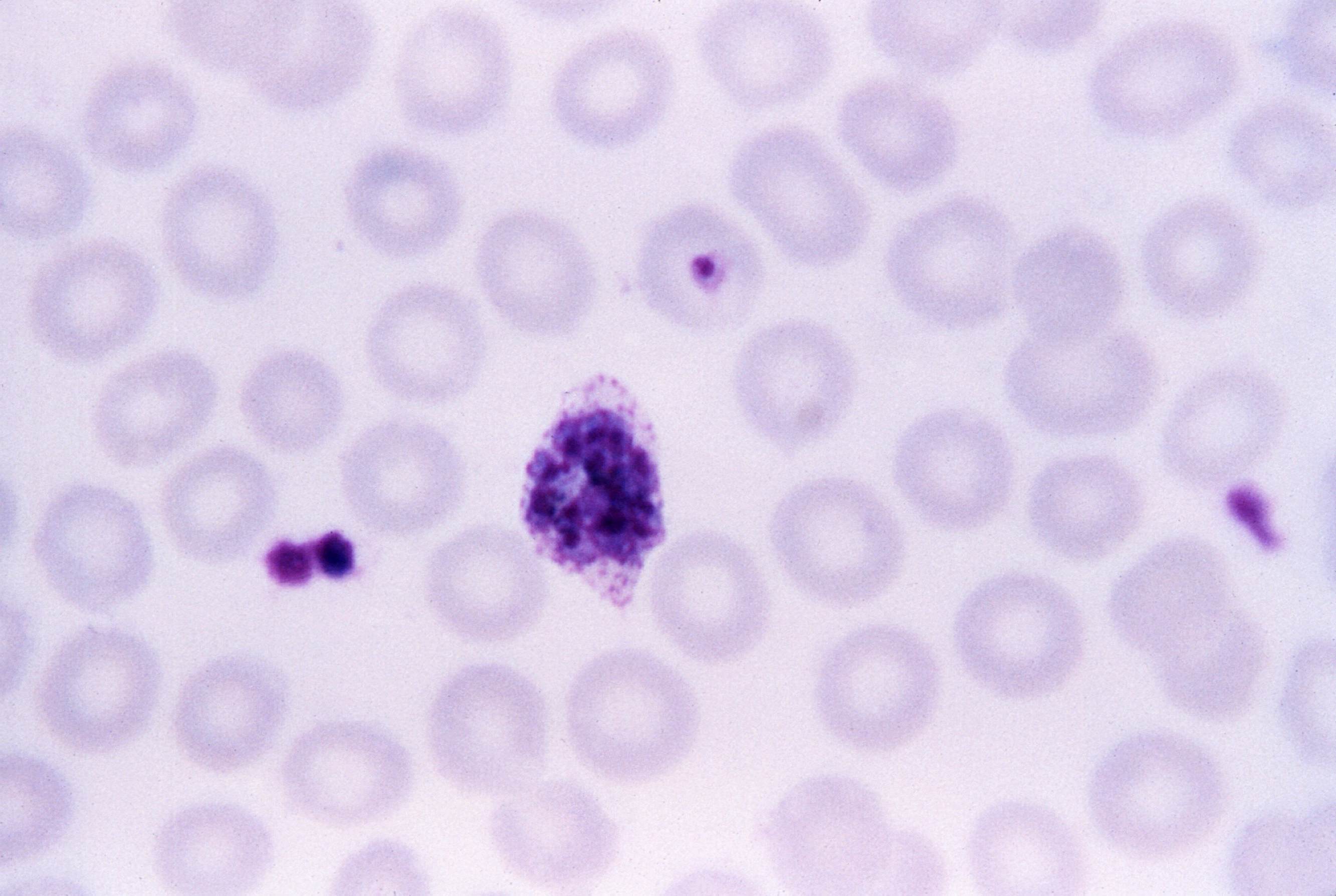 anemia Pernicious