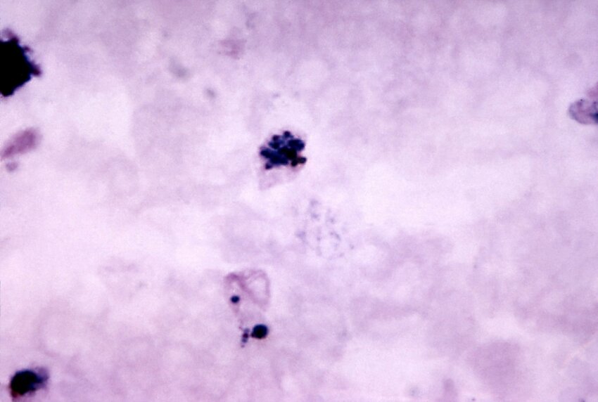 Free Picture Micrograph Mature Plasmodium Vivax Schizont Growing Trophozoite