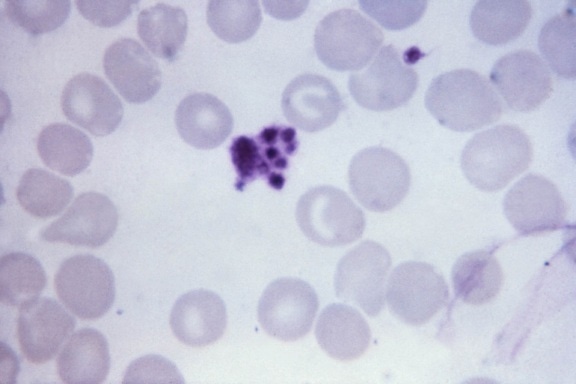 顕微鏡像、血小板、アーティファクト、誤解、マラリア、寄生虫