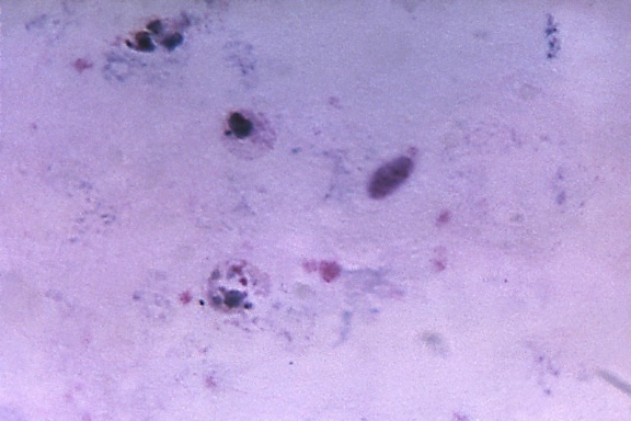 micrograph, two, vivax, trophozoites, fused, platelets, magnified, 1125x