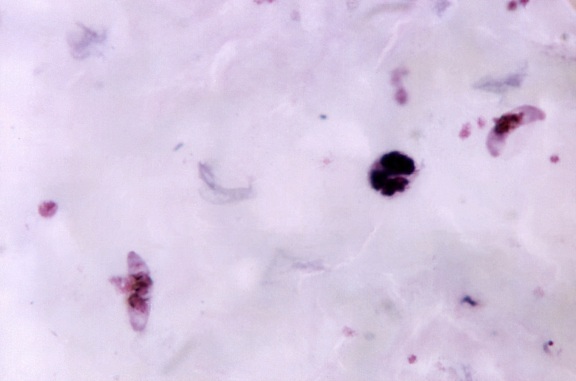 mikroskopische Aufnahme, zwei, rosa, gefärbt, Mondsichel, geformt, Plasmodium falciparum, gametocytes