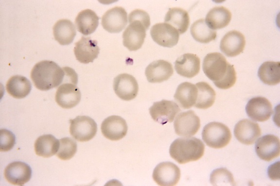 micrographie, deux, falciparum, anneaux, Maurers, points, crénelé, rouge, sang, cellules