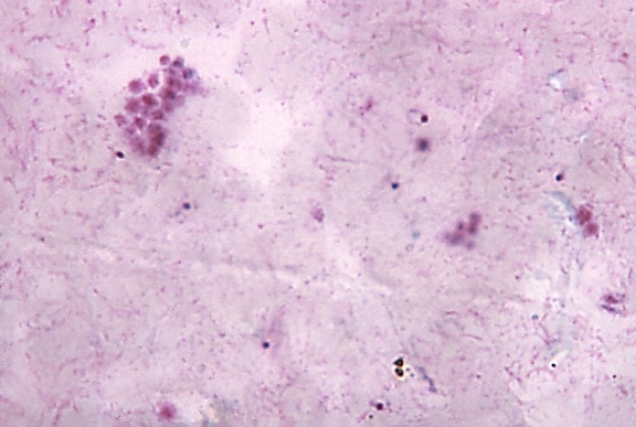 micrograph falciparum, rings, debris, chromatin, visible, cytoplasm
